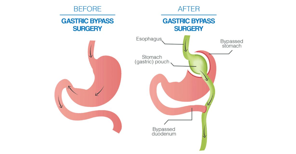 How Soon Can I Drive After Gastric Bypass Surgery